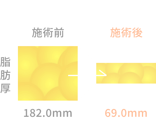 左股関節