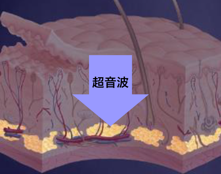 超音波（US）