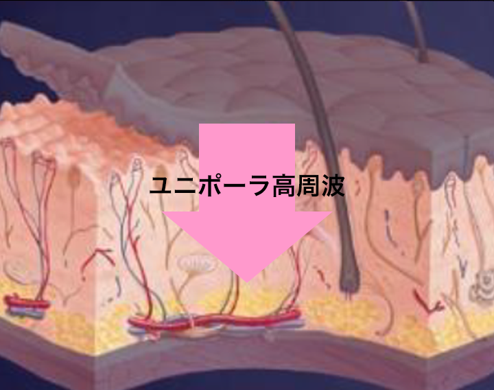 高周波（RF）